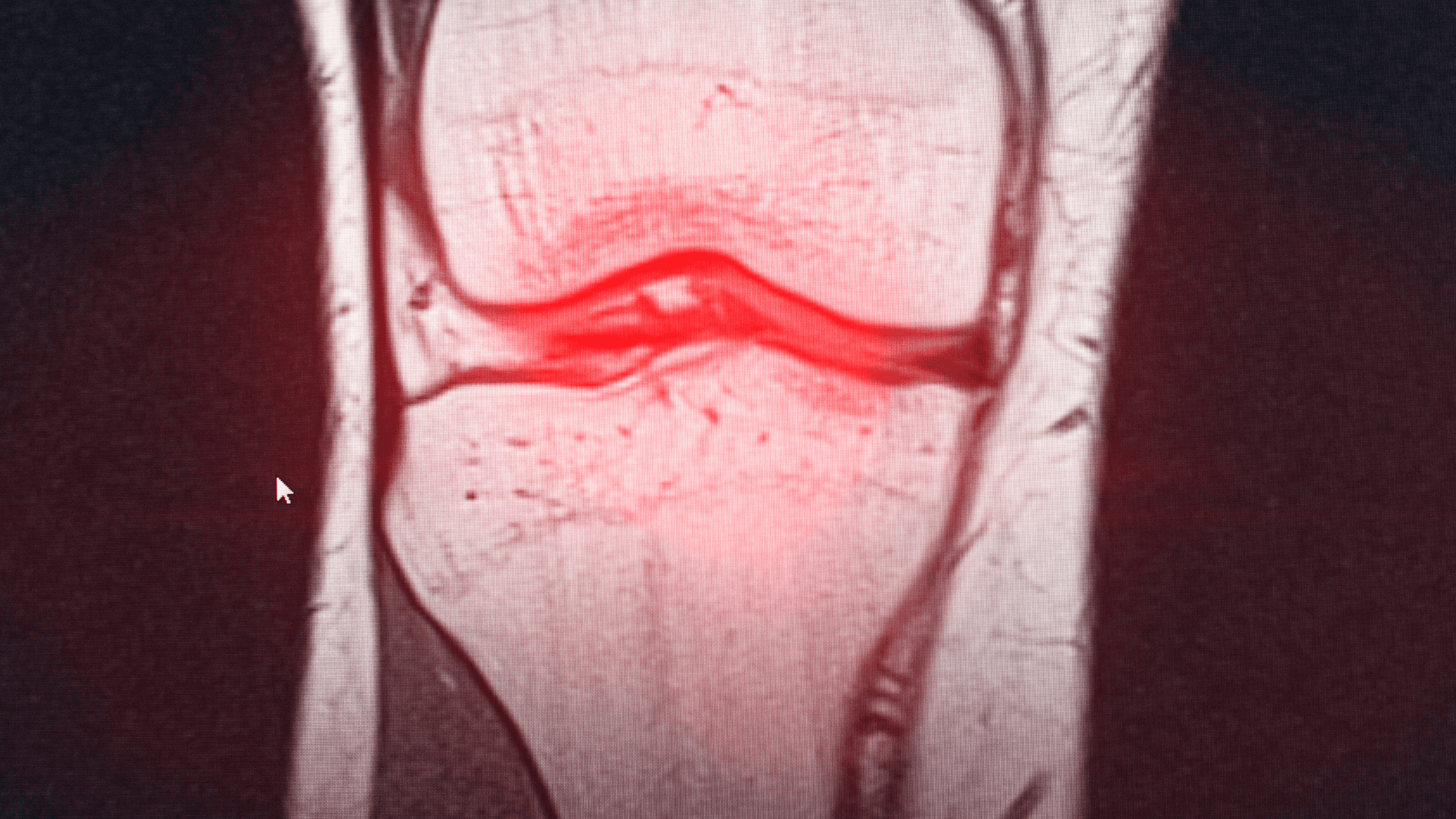 PRP for meniscus tear